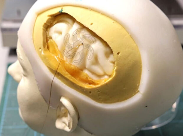 Çin beyin implantının insanlar üzərində uğurlu sınaqdan keçirildiyini açıqlayıb