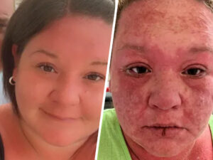 Turist tamamilə keçəl olub və ağcaqanad dişləməsindən sonra dırnaqsız qalıb