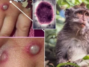 Azərbaycanda meymunçiçəyinə yoluxma qeydə alınıb? – RƏSMİ