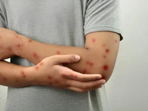 Meymunçiçəyinə yoluxan Azərbaycan vətəndaşı evə buraxıldı