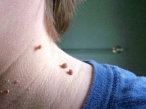 Ziyillərin, xalların yandırılması xərçəng yaradır?- Həkim-kosmetoloqdan AÇIQLAMA