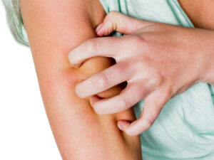 Alimlər həşərat dişləmələrini cızmağın gözlənilməz faydalarını tapdılar