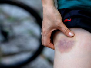 Bədəndə qalıcı qançırların göstərdiyi xəstəliklər açıqlanıb