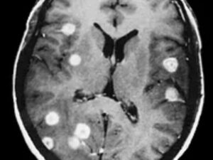 Alimlər xərçəngin yayılmasını dayandıra biləcək yeni mexanizm kəşf ediblər