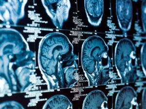 Zülalın beyin xərçənginin aqressivliyini artırdığı aşkar edilib