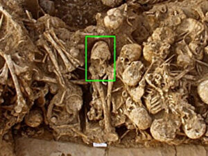 İranda süni şəkildə deformasiyaya uğramış qızın 6200 illik kəllə sümüyü tapılıb