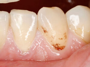 Həkim kariyesin öpüşmə yolu ilə keçə biləcəyini izah edib