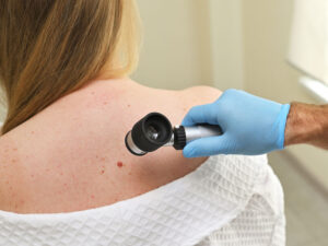 Zəiflik davamlı dəri xərçəngində aşkar edilmişdir