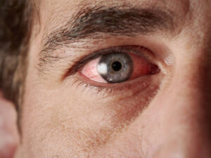 Həkim yaşlı insanların niyə gözləri sulu olduğunu izah etdi