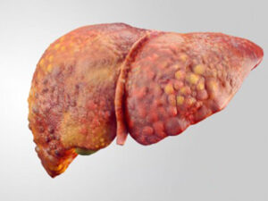 Ağır qaraciyər iltihabının səbəbi tapıldı Ağır qaraciyər iltihabının səbəbi tapıldı