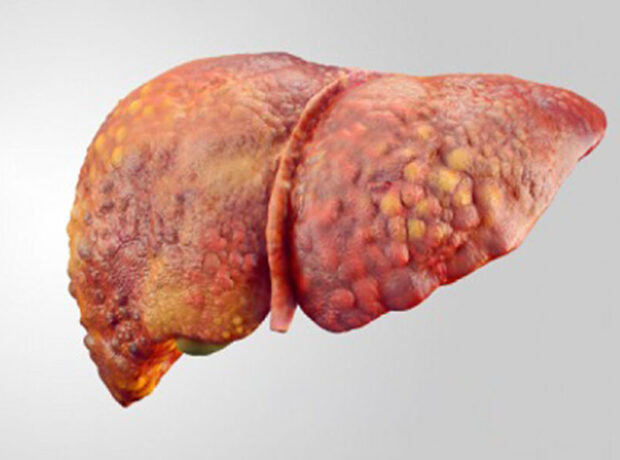Ağır qaraciyər iltihabının səbəbi tapıldı Ağır qaraciyər iltihabının səbəbi tapıldı