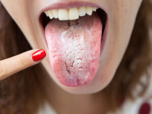 Dildə ləkələrin yaranmasının təhlükəli səbəbi müəyyən edilmişdir Dildə ləkələrin yaranmasının təhlükəli səbəbi müəyyən edilmişdir