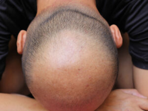 Bir həkim saç tökülməsi ilə bağlı iki geniş yayılmış mifi təkzib etdi Bir həkim saç tökülməsi ilə bağlı iki geniş yayılmış mifi təkzib etdi