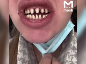 Rusiyada vinirlərin quraşdırılmasından sonra bir qız dişsiz qalıb Rusiyada vinirlərin quraşdırılmasından sonra bir qız dişsiz qalıb